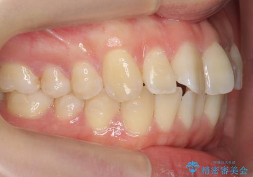 インビザライン モニター治療 前歯のねじれをまっすぐに の治療中