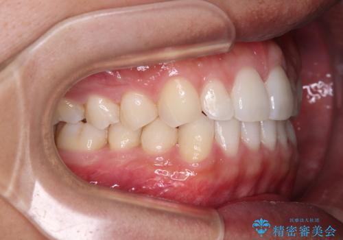 前歯のデコボコとクロスバイト インビザライン矯正治療の治療後