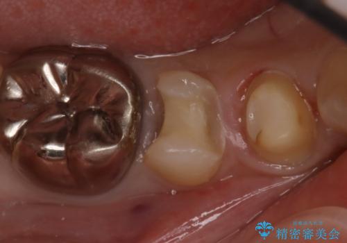 歯の形が気になる セラミックでキレイな歯に!の治療中