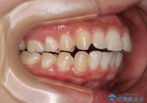 前に出ている上顎 抜歯矯正で唇を閉じやすくの治療前