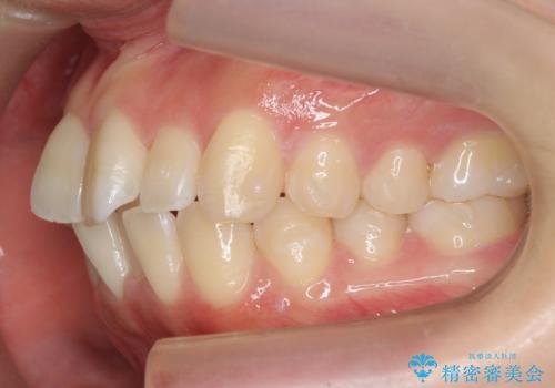 インビザライン モニター治療 前歯のねじれをまっすぐに の治療中