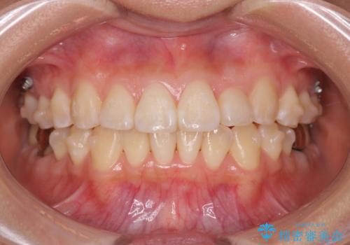 正中のズレ、引っ込んだ前歯の矯正の治療中