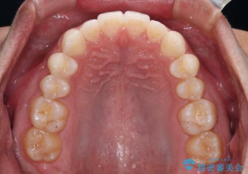 前歯のデコボコとクロスバイト インビザライン矯正治療の治療後