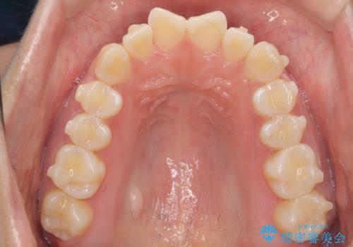 インビザライン モニター治療 前歯のねじれをまっすぐに の治療中