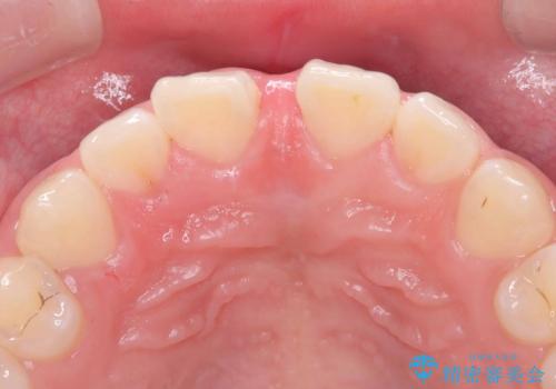 【上唇小帯切除術】子どもの頃から上の前歯の歯茎が気になってた!の治療後
