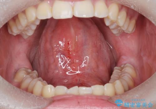 舌が動かしにくい。の症例 治療後