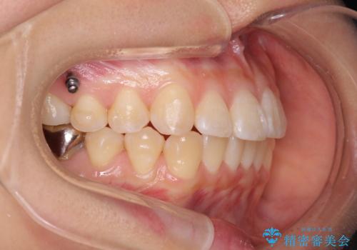 正中のズレ、引っ込んだ前歯の矯正の治療中