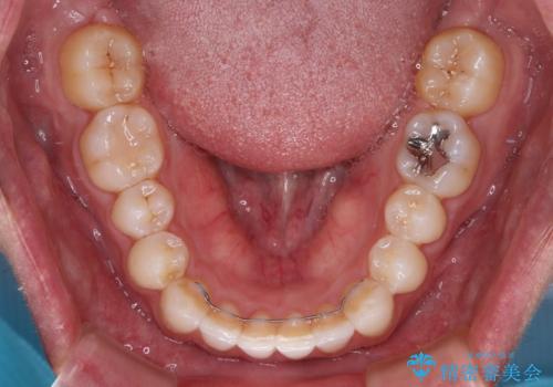 前歯のデコボコとクロスバイト　インビザライン矯正治療の治療後