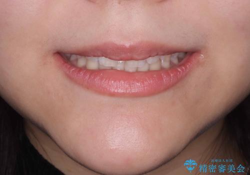 【上唇小帯切除術】子どもの頃から上の前歯の歯茎が気になってた!の治療後