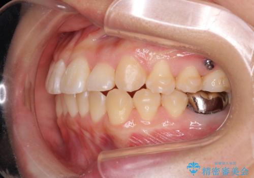 正中のズレ、引っ込んだ前歯の矯正の治療中