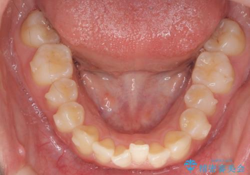 インビザライン　モニター治療　前歯のねじれをまっすぐに　の治療中