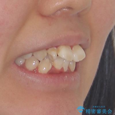 唇からはみ出るほど飛び出した前歯 ワイヤー装置による抜歯矯正の治療前(顔貌)