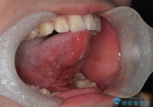 舌が動かしにくい。の治療後