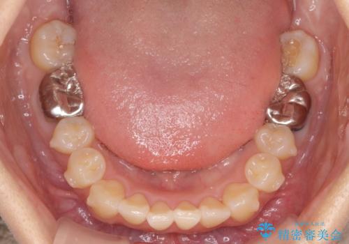 正中のズレ、引っ込んだ前歯の矯正の治療中