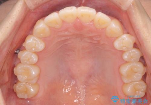 正中のズレ、引っ込んだ前歯の矯正の治療中