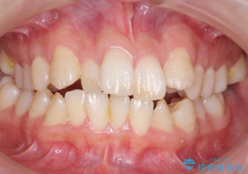 難症例　奥歯がかみ合っていない　歯並び矯正で別人にの症例 治療前