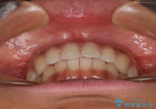 前歯のデコボコを治したい インビザライン・モデレートによる矯正治療の治療中