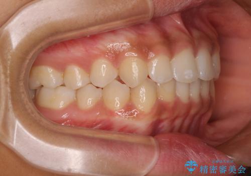 前歯のデコボコを治したい インビザライン・モデレートによる矯正治療の治療中