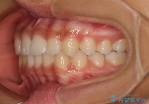 前歯のデコボコを治したい インビザライン・モデレートによる矯正治療の治療中