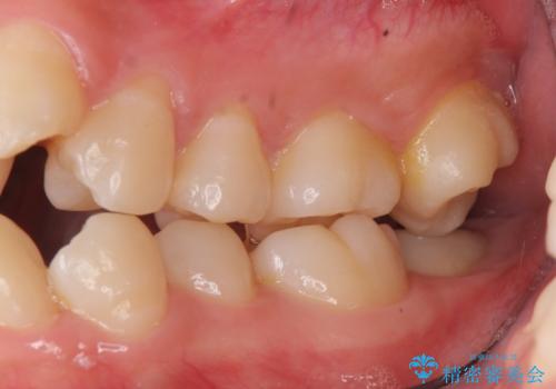 難症例 奥歯がかみ合っていない 歯並び矯正で別人にの治療前