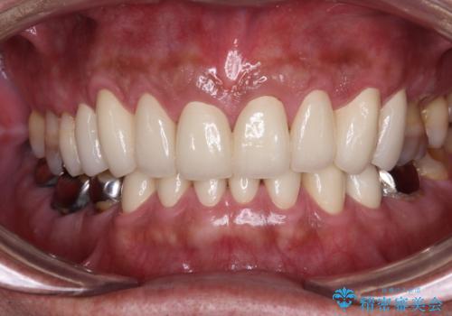 黄ばんだ前歯をきれいに　前歯の審美歯科治療の治療後