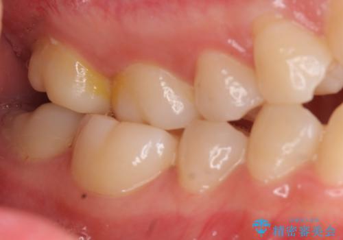 難症例 奥歯がかみ合っていない 歯並び矯正で別人にの治療前