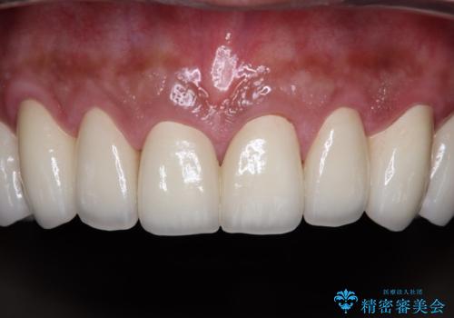 黄ばんだ前歯をきれいに 前歯の審美歯科治療の治療後