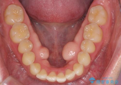 下あごの骨隆起が気になる。の症例 治療前