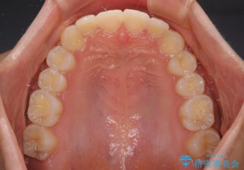 前歯のデコボコを治したい インビザライン・モデレートによる矯正治療の治療中