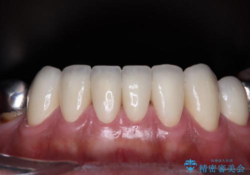 黄ばんだ前歯をきれいに 前歯の審美歯科治療の治療後