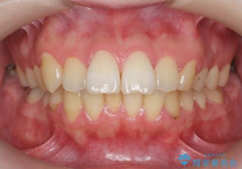 歯を抜かずに行う前歯の角度の改善の症例 治療前