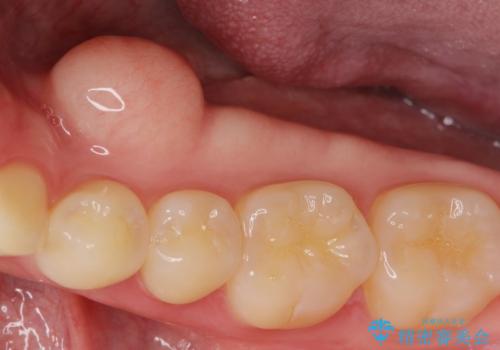 下あごの骨隆起が気になる。の治療前