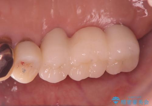 奥歯で咬むと痛いの治療後