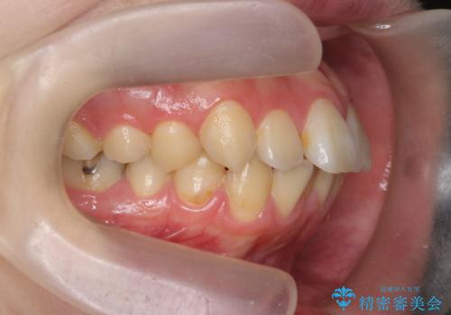 歯を抜かずに行う前歯の角度の改善の治療前