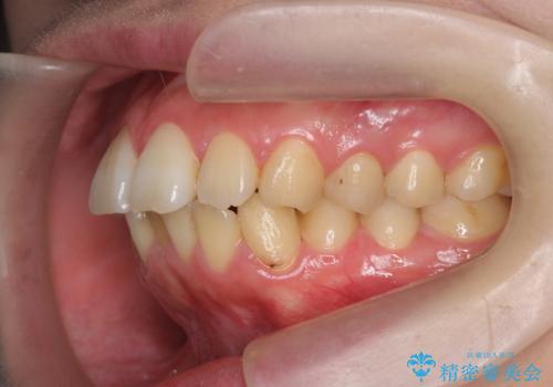 歯を抜かずに行う前歯の角度の改善の治療前