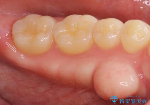 下あごの骨隆起が気になる。の治療前