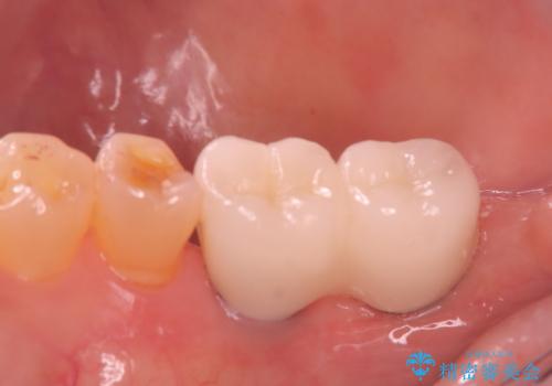 奥歯で咬むと痛いの症例 治療後