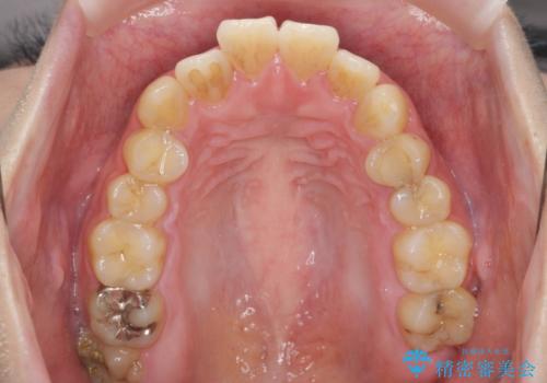 歯を抜かずに行う前歯の角度の改善の治療前