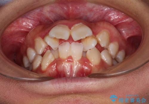 唇からはみ出るほど飛び出した前歯　ワイヤー装置による抜歯矯正の治療前