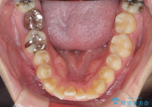 歯を抜かずに行う前歯の角度の改善の治療前