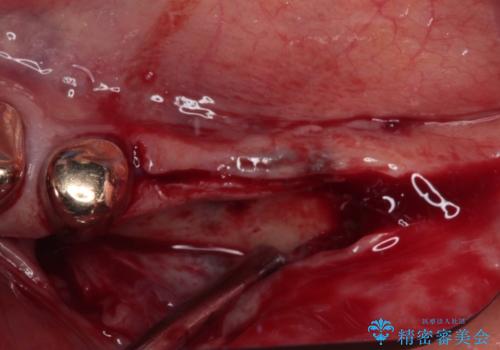入れ歯を使いたくない 細い骨にインプラントを埋入した補綴治療の治療前