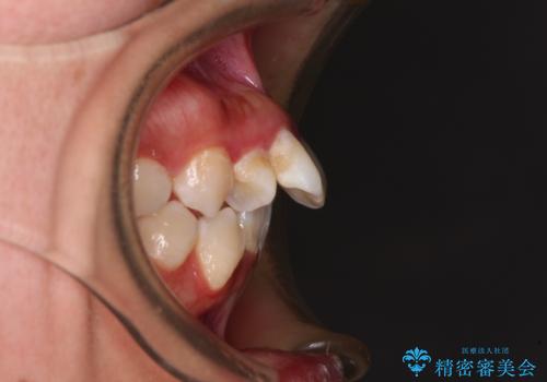 唇からはみ出るほど飛び出した前歯　ワイヤー装置による抜歯矯正の治療前
