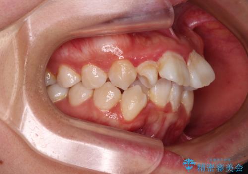 唇からはみ出るほど飛び出した前歯 ワイヤー装置による抜歯矯正の治療前