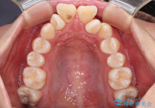 唇からはみ出るほど飛び出した前歯 ワイヤー装置による抜歯矯正の治療前