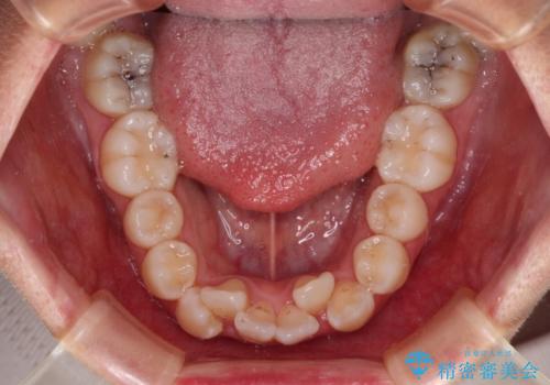 唇からはみ出るほど飛び出した前歯 ワイヤー装置による抜歯矯正の治療前
