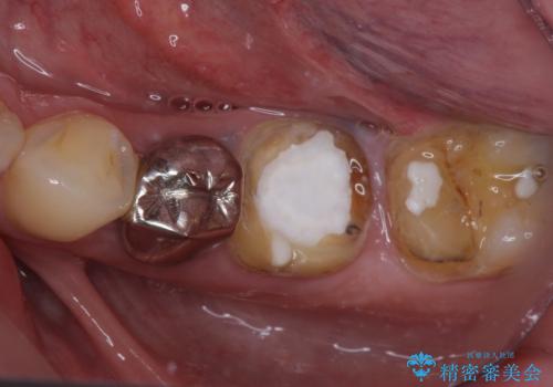 欠損と治療途中の奥歯 インプラント治療と補綴治療の治療前