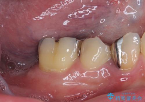 欠損と治療途中の奥歯 インプラント治療と補綴治療の治療前