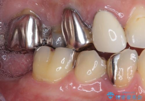 欠損と治療途中の奥歯 インプラント治療と補綴治療の治療前
