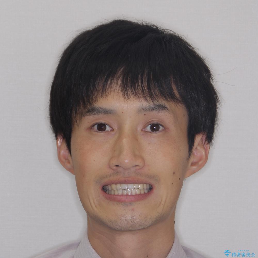 【モニター】前歯に隙間ができるほどのディープバイト ワイヤー装置で負担の少ない咬み合わせにの治療後(顔貌)