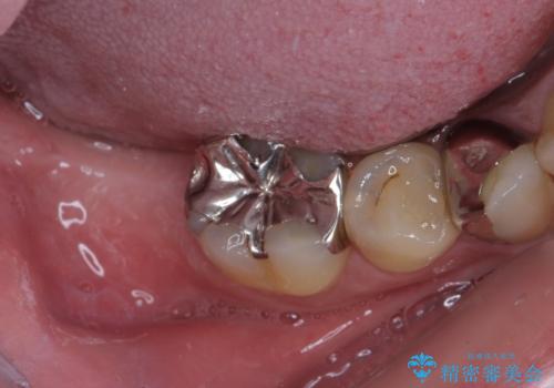 欠損と治療途中の奥歯 インプラント治療と補綴治療の治療前